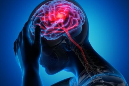 Czym jest migrena okoporaźna?