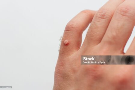 Skuteczne i bezpieczne usuwanie zmian skórnych – brodawki Poznań